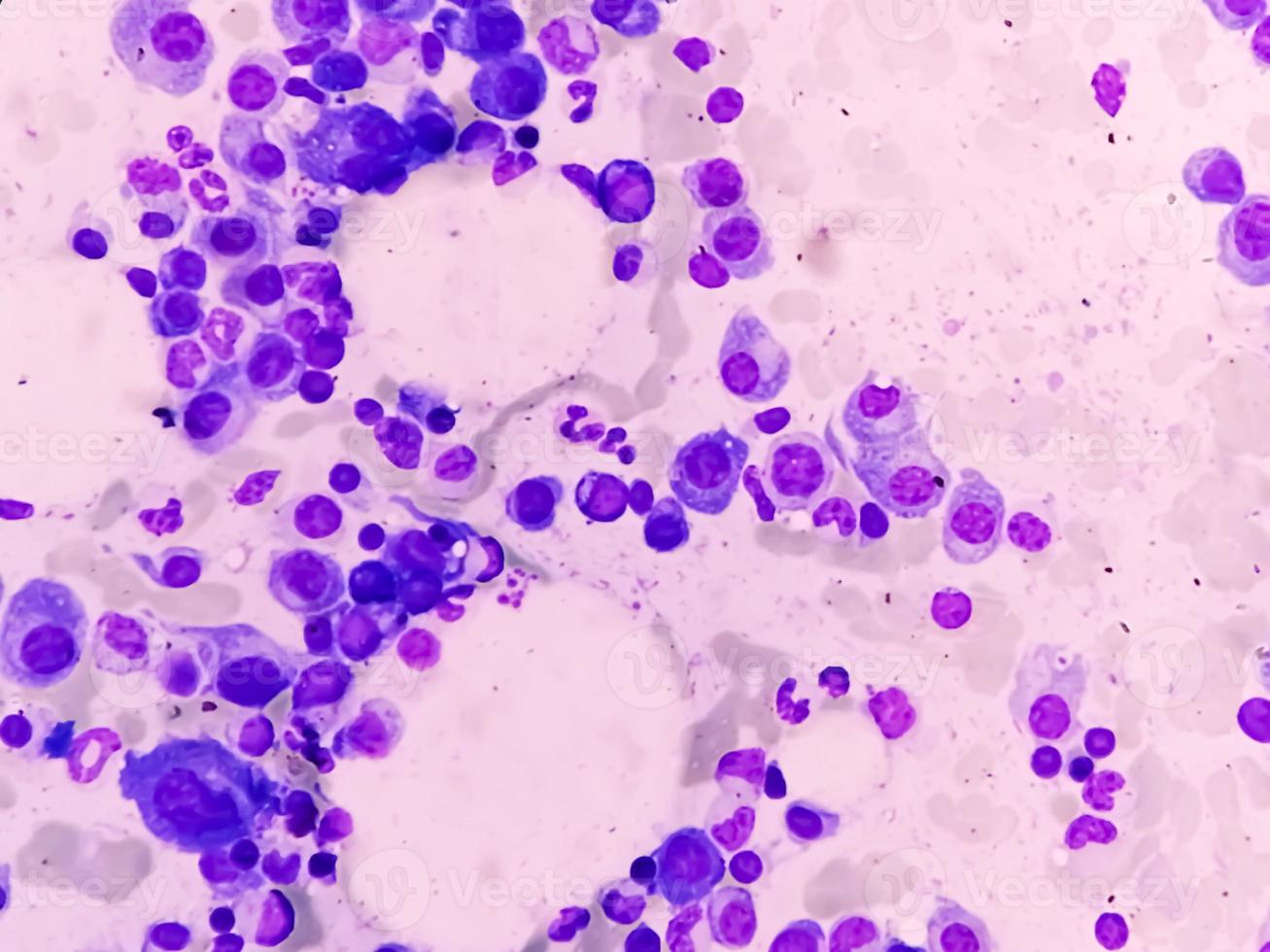 Microscopic view of bone marrow slide feature are suggestive Multiple myeloma, also known as myeloma, is a type of bone marrow cancer. photo