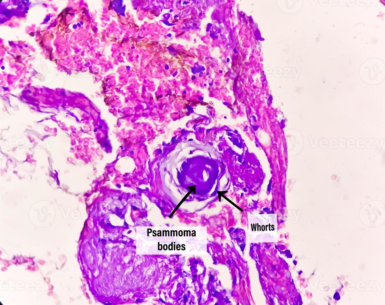 Spinal tumor biopsy showing Psammomatous meningioma. Psammoma bodies. photo