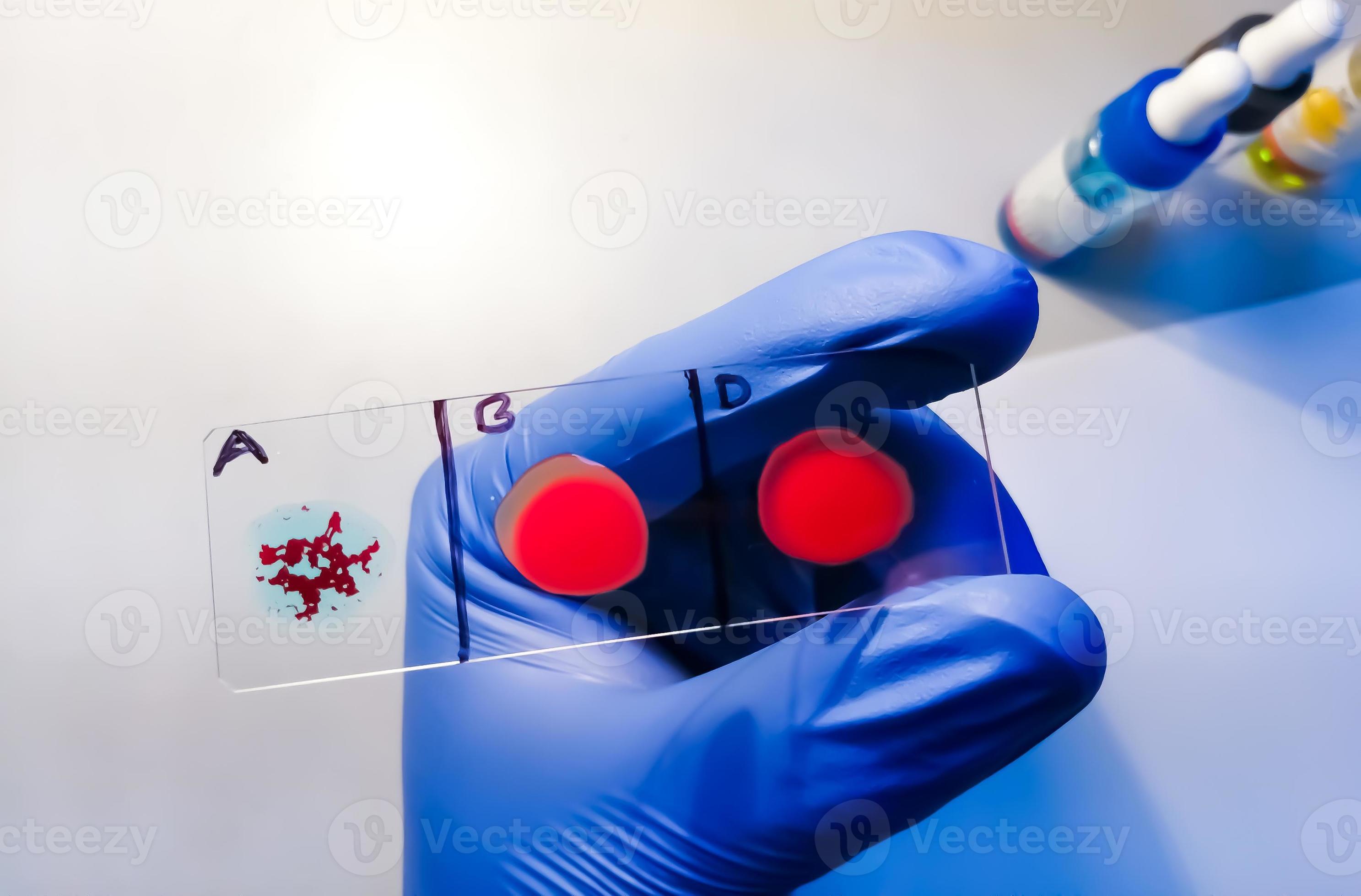 A Negative Blood Type One Of The Rare Blood Group In Worldwide Blood Group And Rh Factor