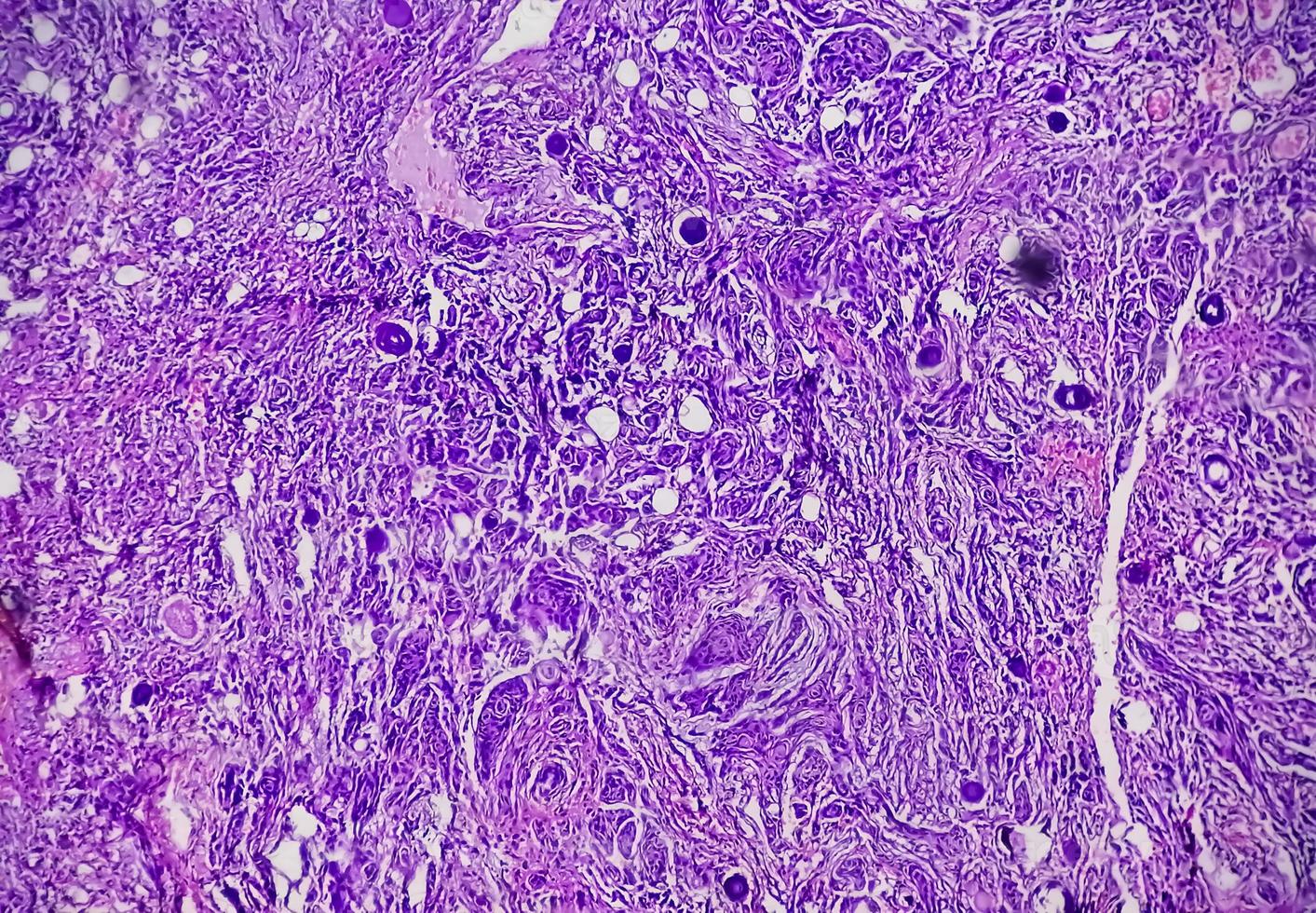 Spinal tumor biopsy showing Psammomatous meningioma. Psammoma bodies. photo