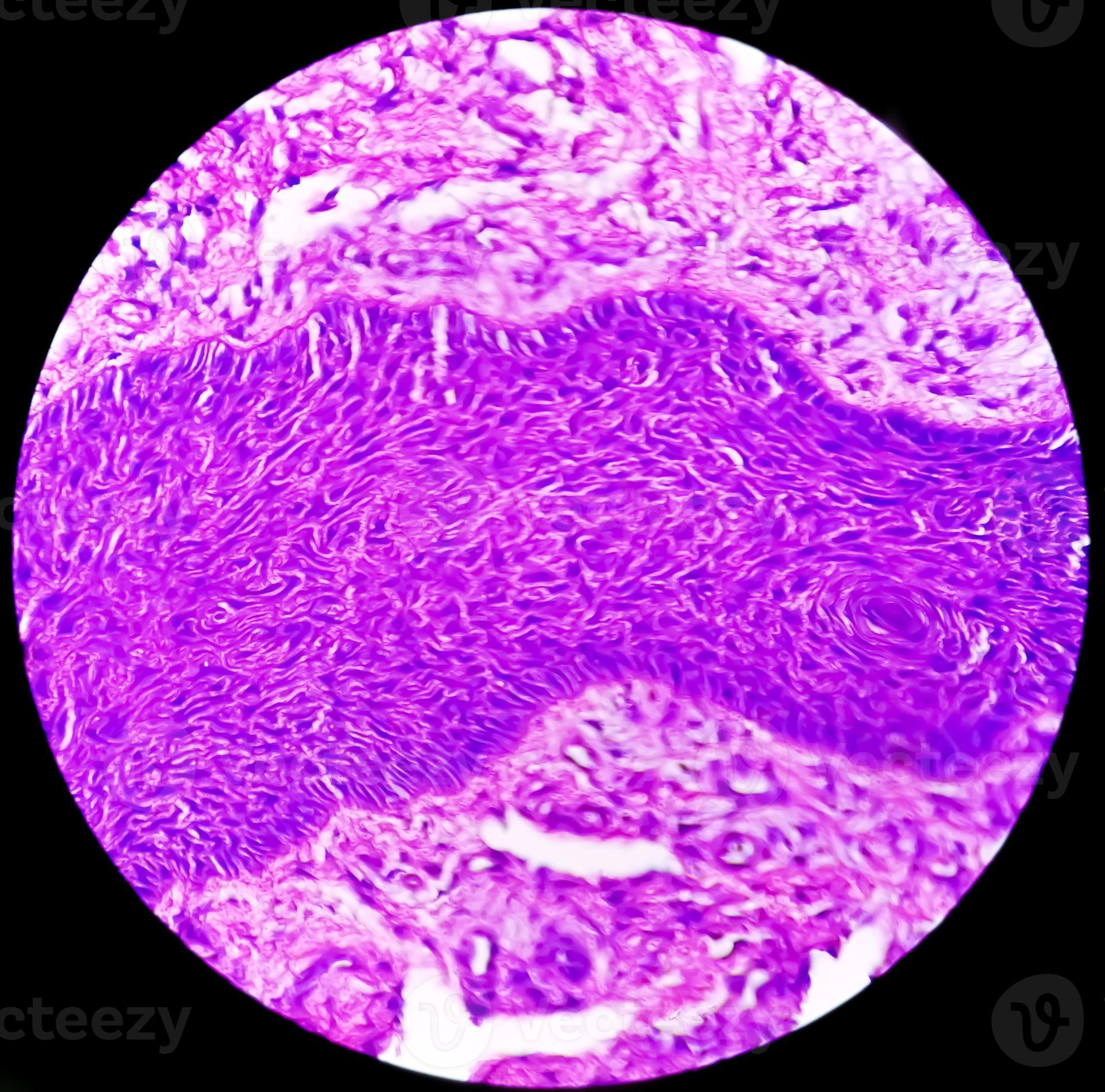 Skin biopsy, Suggestive of Basal cell carcinoma, the most common type