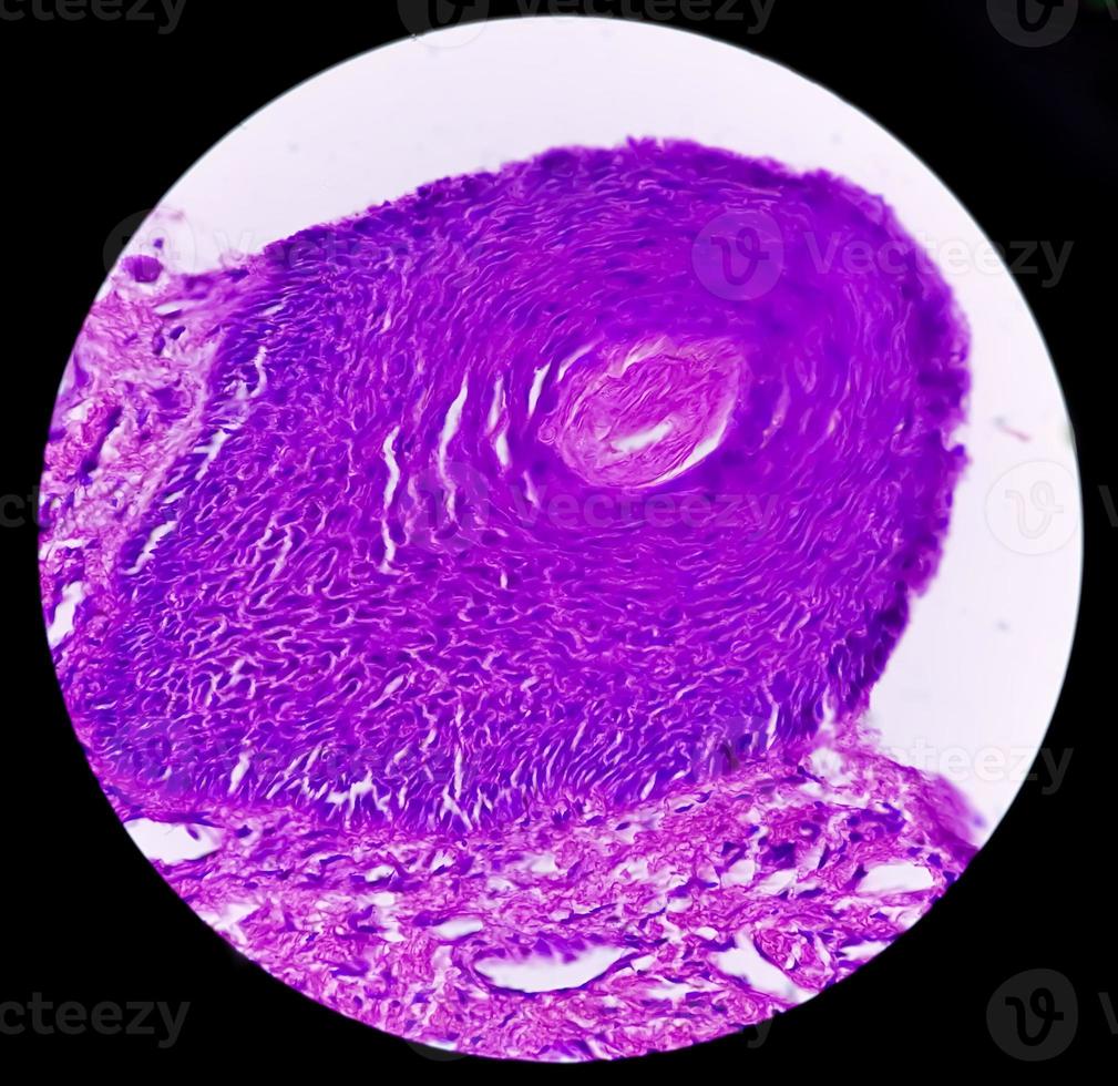 Skin biopsy, Suggestive of Basal cell carcinoma, the most common type of skin cancer. photo
