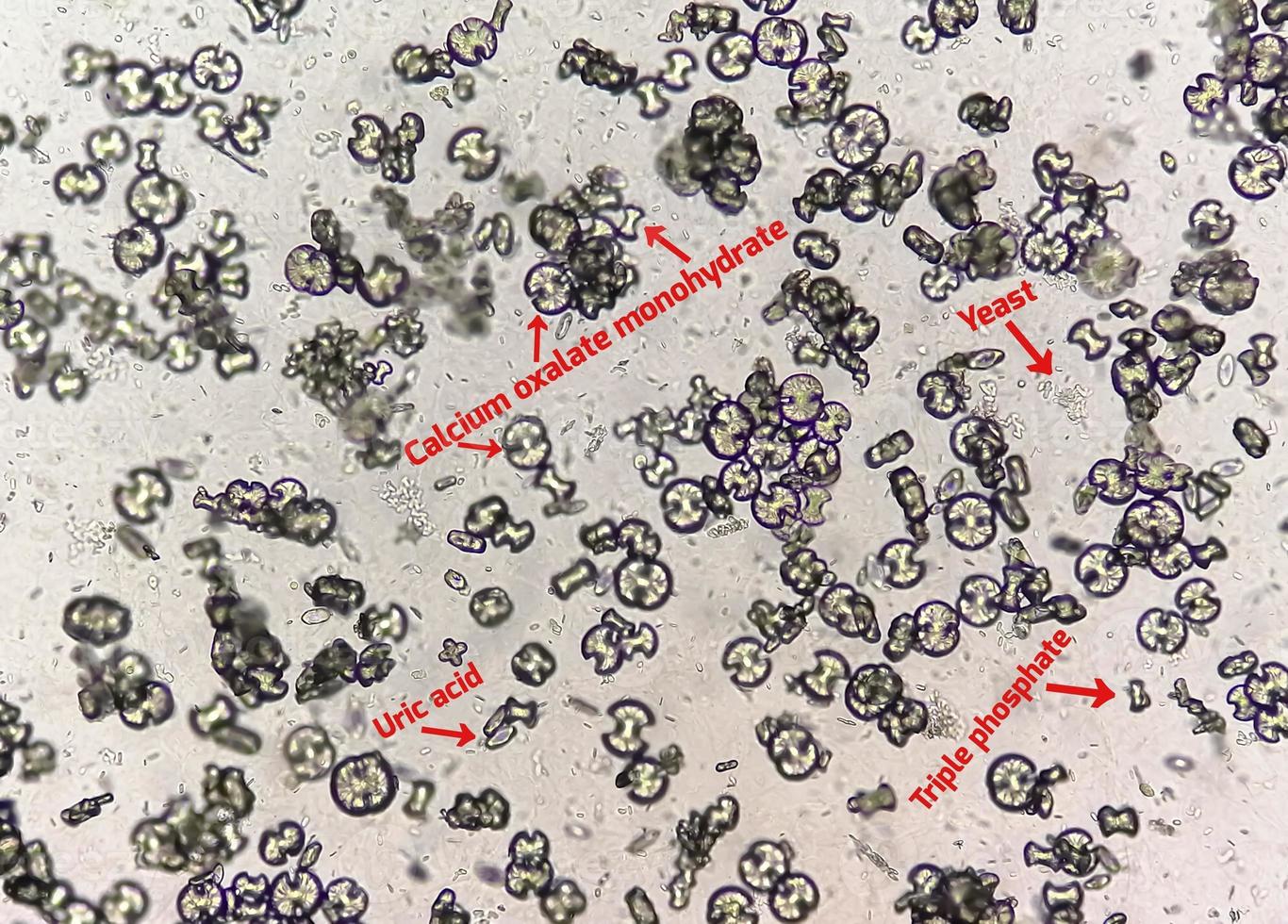 Microscopic image showing calcium oxalate monohydrate, uric acid crystals and triple phosphate crystals from urine sediment. UTI. kidney disease. photo