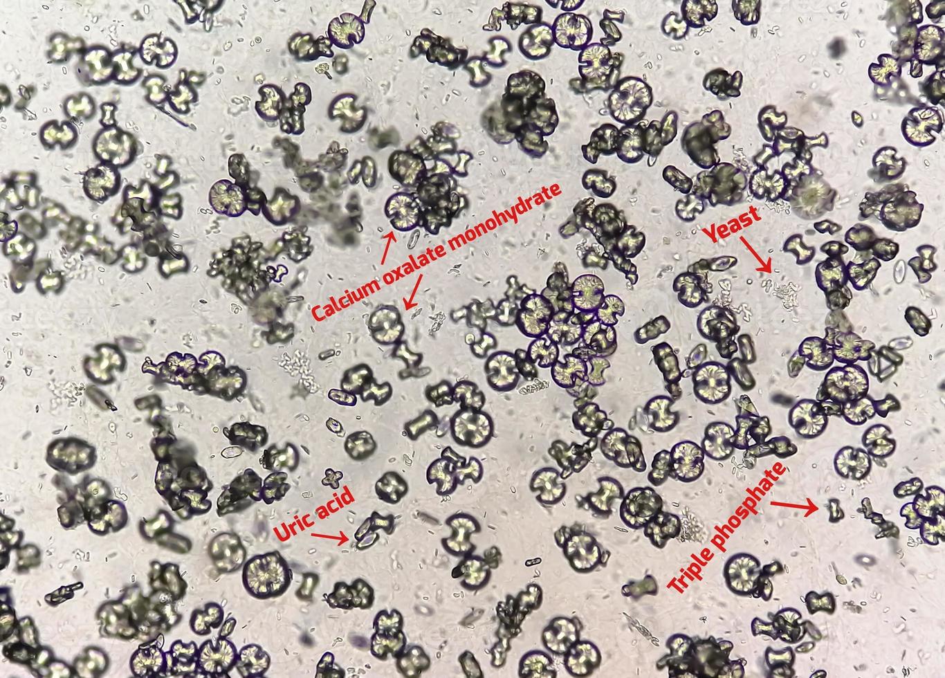 Microscopic image showing calcium oxalate monohydrate, uric acid crystals and triple phosphate