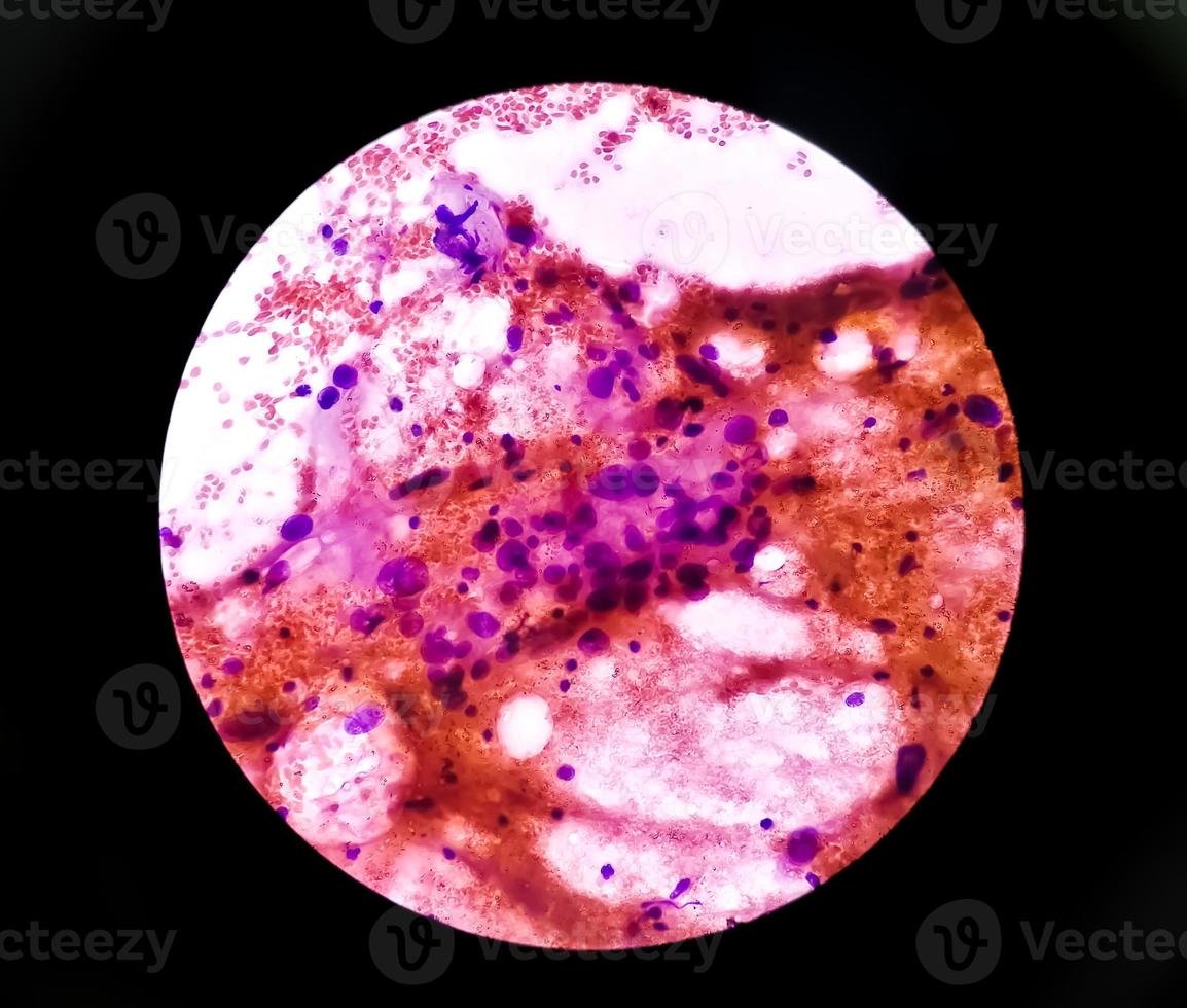 Cytological study of intra abdominal mass, Spindle cell sarcoma, positive for malignant cells. Pleomorphic undifferentiated sarcoma, malignant fibrous histiocytoma. photo