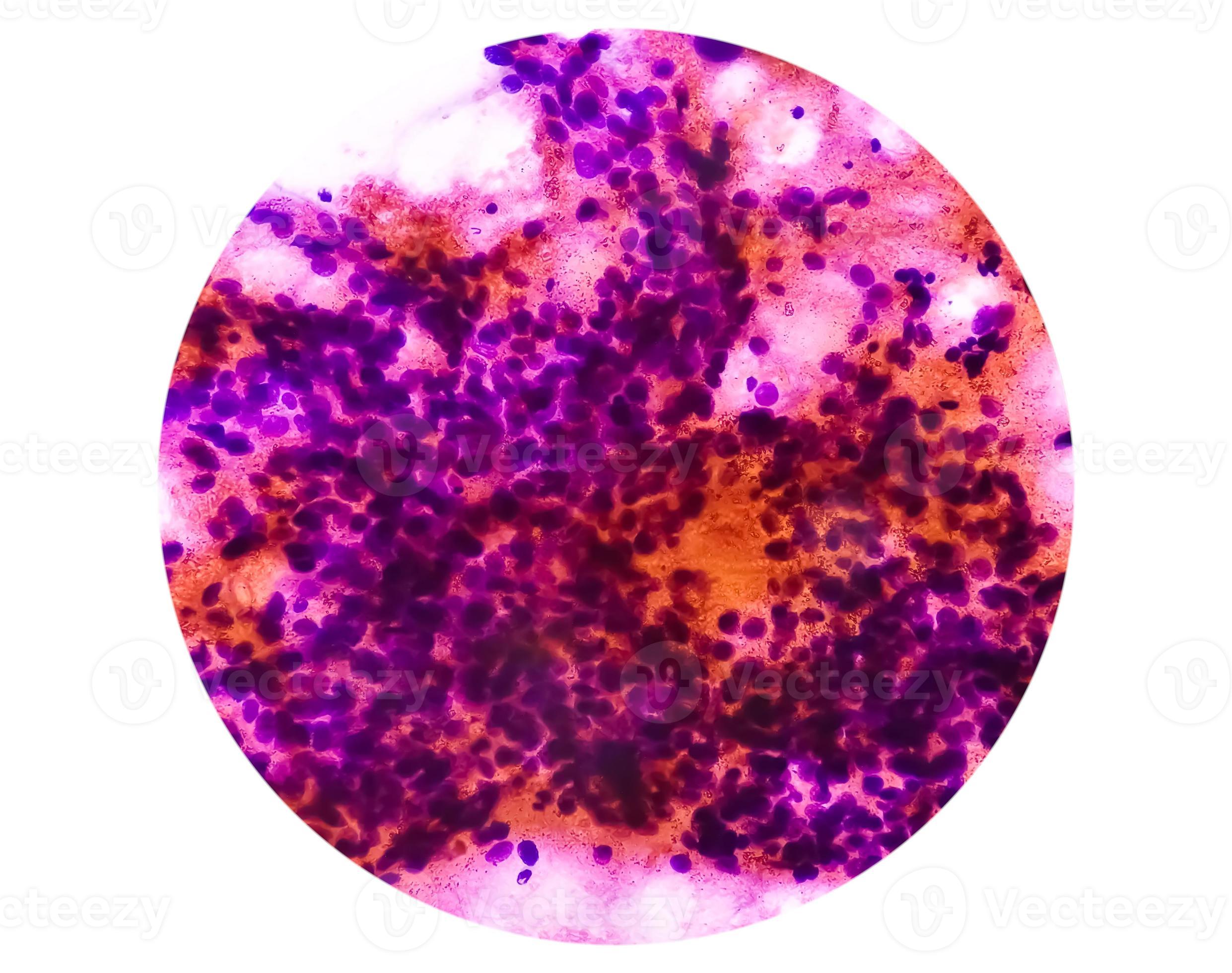 Cytological study of intra abdominal mass, Spindle cell