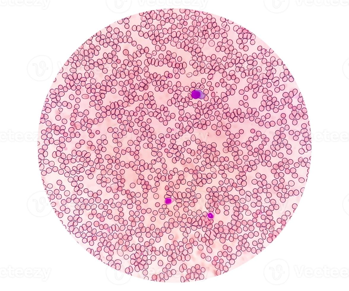 Microscopic view of hematological stained slide. thrombocytopenia. Extremely low level of platelet count in blood. photo