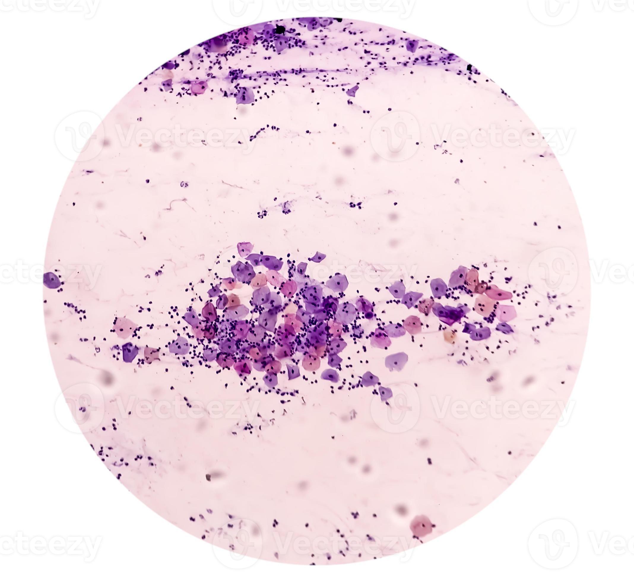 Microscopic view of PAP #39 S smear showing severe negative for Microscopic view of PAP #39 S smear showing severe negative for