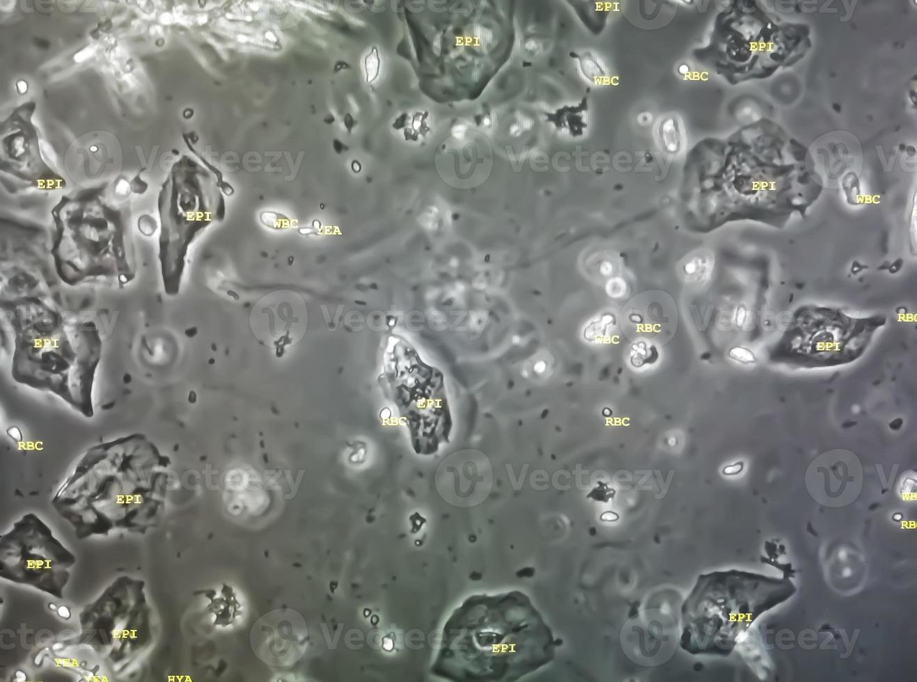 Microscopic image of abnormal urinalysis. urine exam. Urine routine examination. photo