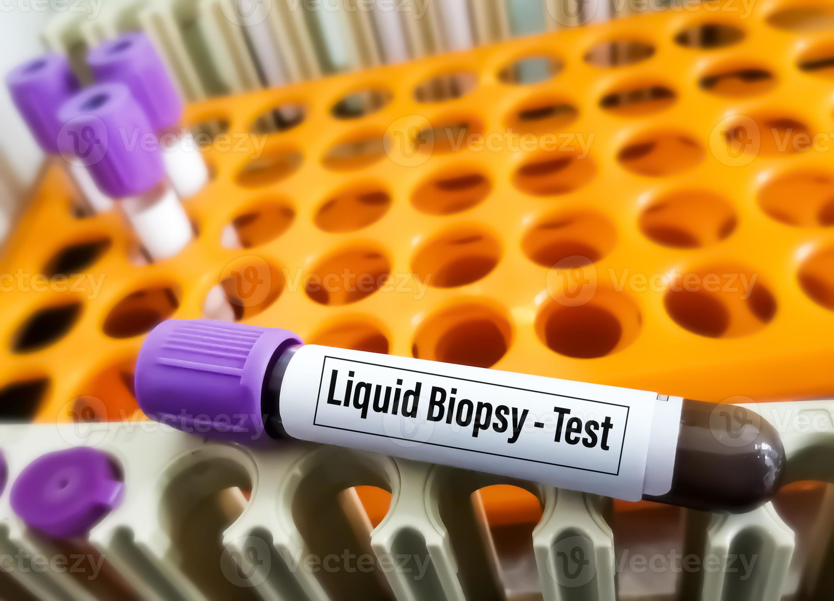 Blood Samples For Liquid Biopsy Blood Test To Detect Cancer Cells Or blood-samples-for-liquid-biopsy-blood-test-to-detect-cancer-cells-or