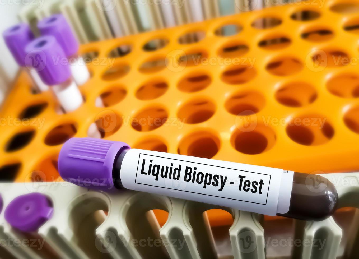 Blood samples for Liquid biopsy blood test to detect cancer cells or DNA fragments that circulate in the bloodstream, Lung cancer, laboratory background. photo