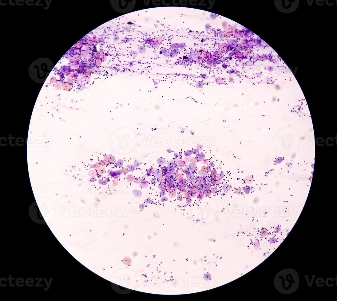 Microscopic view of PAP'S smear showing severe negative for intraepithelial lesion malignancy or NILM.  cervical cancer diagnosis. photo