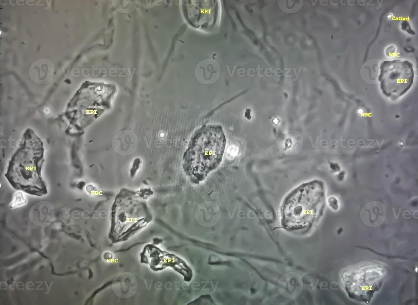 Microscopic image of abnormal urinalysis. urine exam. Urine routine examination. 12601202 Stock
