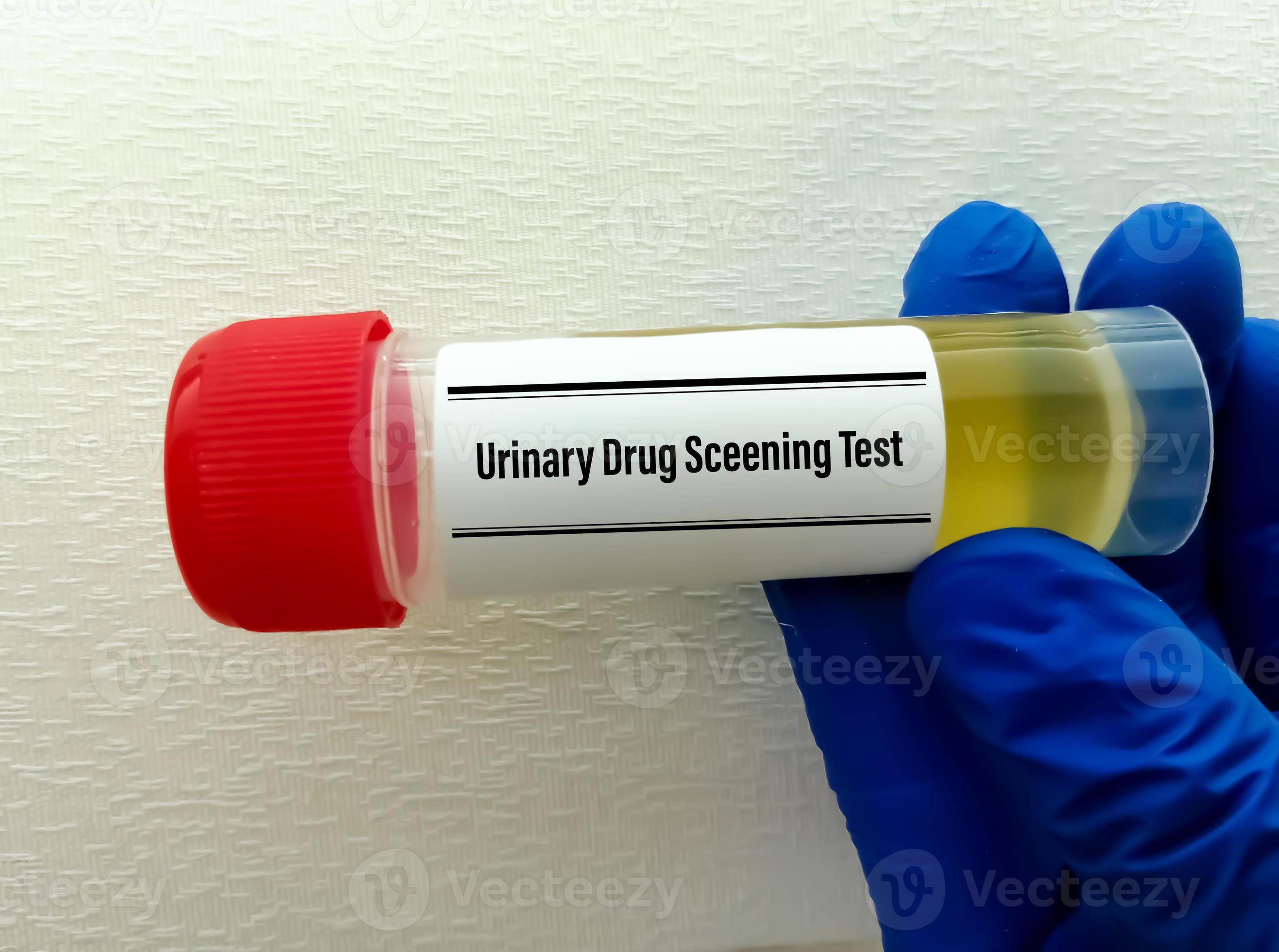 Lab technician holds Urine sample for drug screen test, for the
