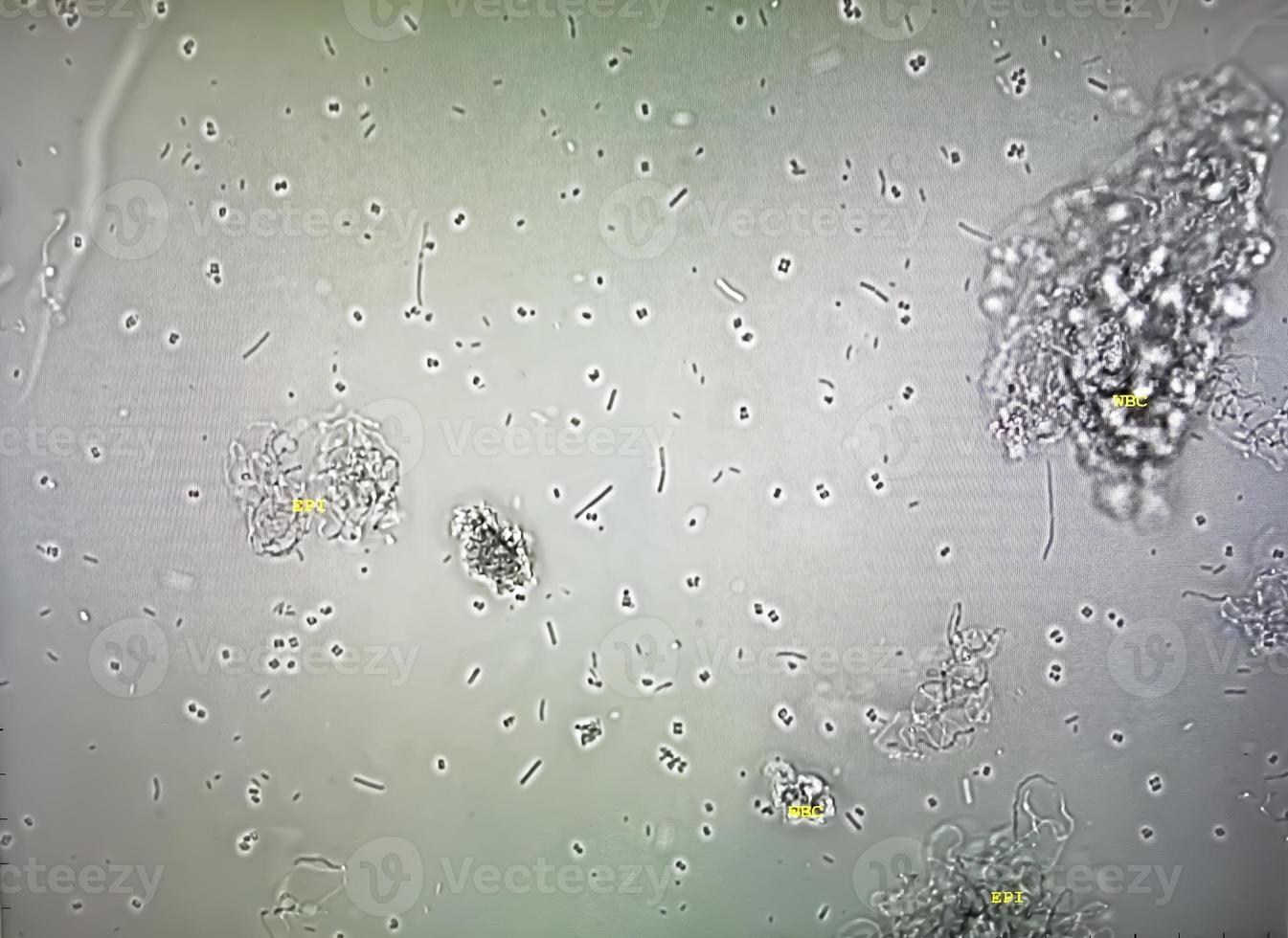 Microscopic image of abnormal urinalysis. urine exam. Urine routine examination. photo