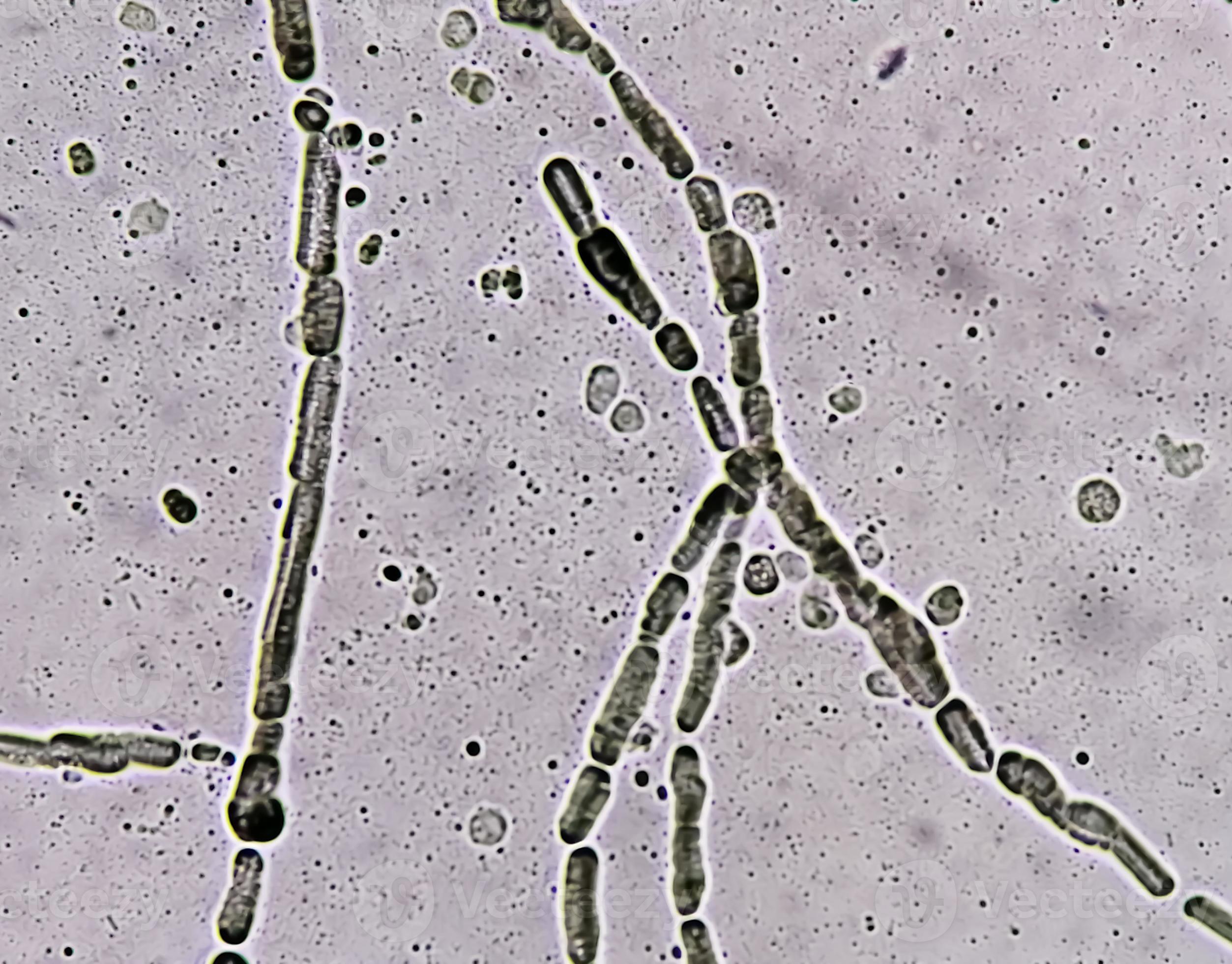 Photomicrograph showing Hyphae of dermatophytes, Nail scraping for