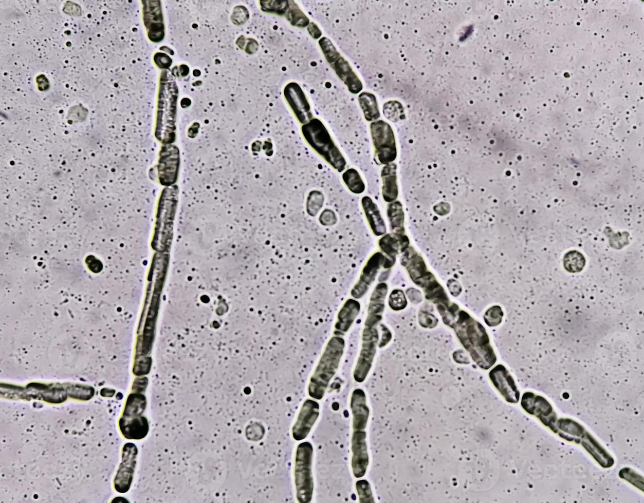 Photomicrograph showing Hyphae of dermatophytes, Nail scraping for fungus test photo