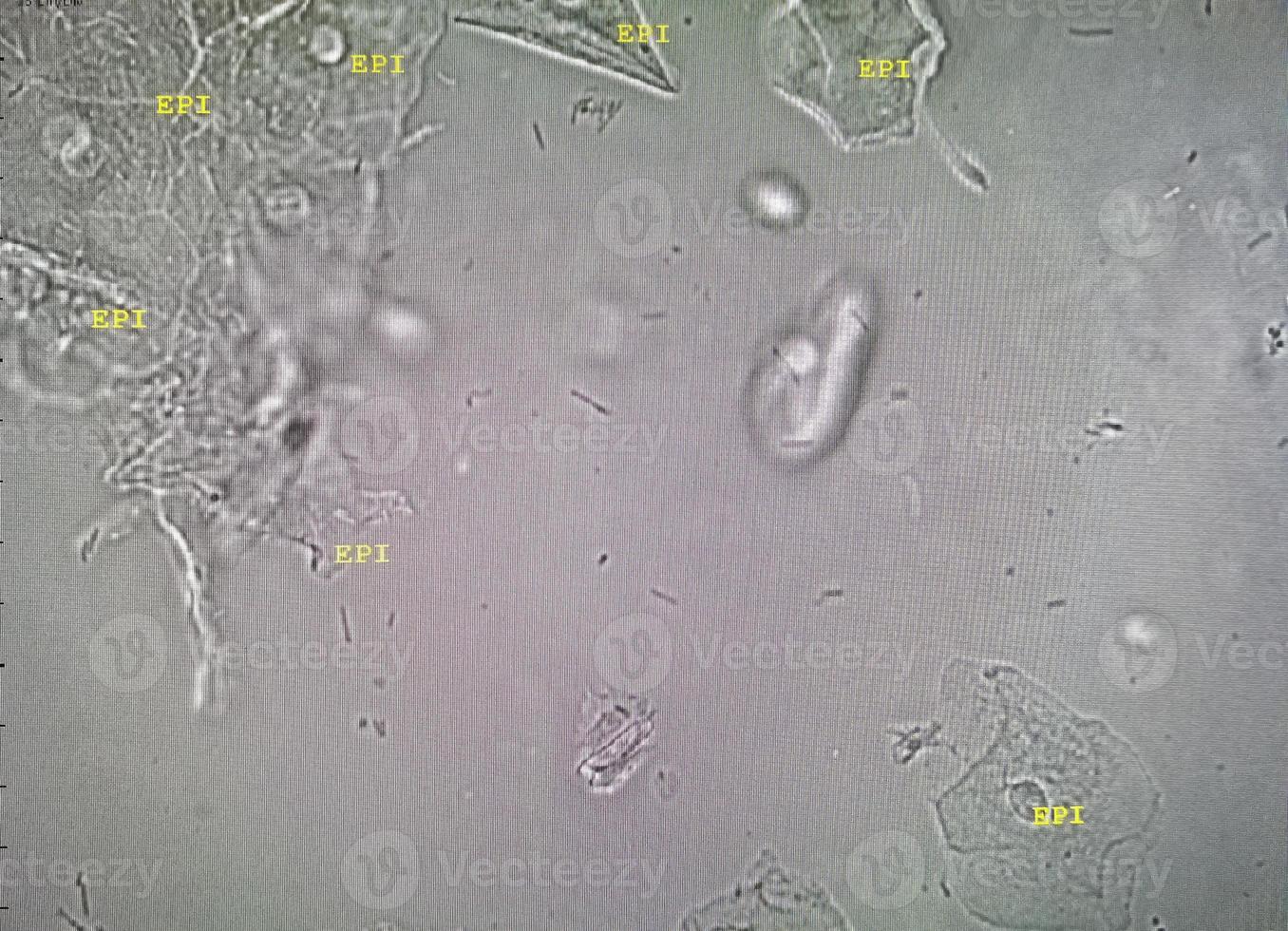 Microscopic image of abnormal urinalysis. urine exam. Urine routine examination. photo