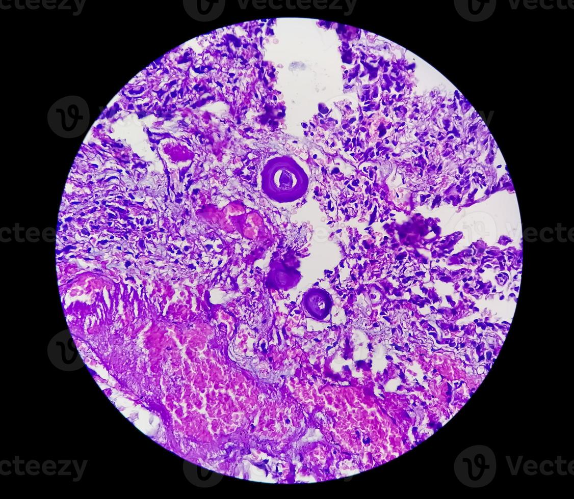 Spinal tumor biopsy showing Psammomatous meningioma. Psammoma bodies. photo