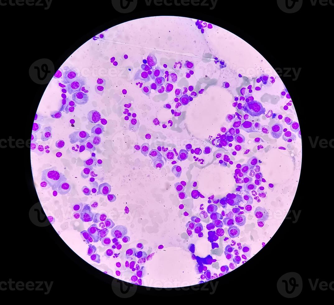 Microscopic view of bone marrow slide feature are suggestive Multiple myeloma, also known as myeloma, is a type of bone marrow cancer. photo