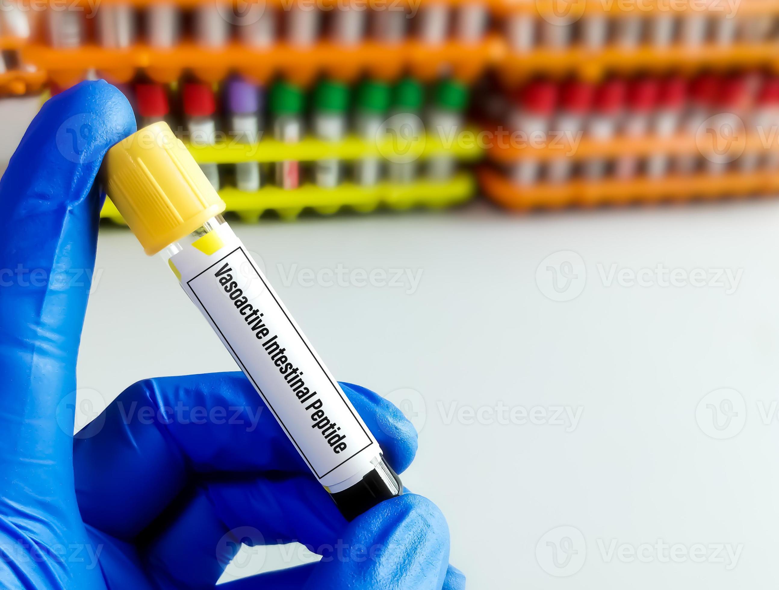 Scientist holding a blood sample for Vasoactive intestinal peptide test