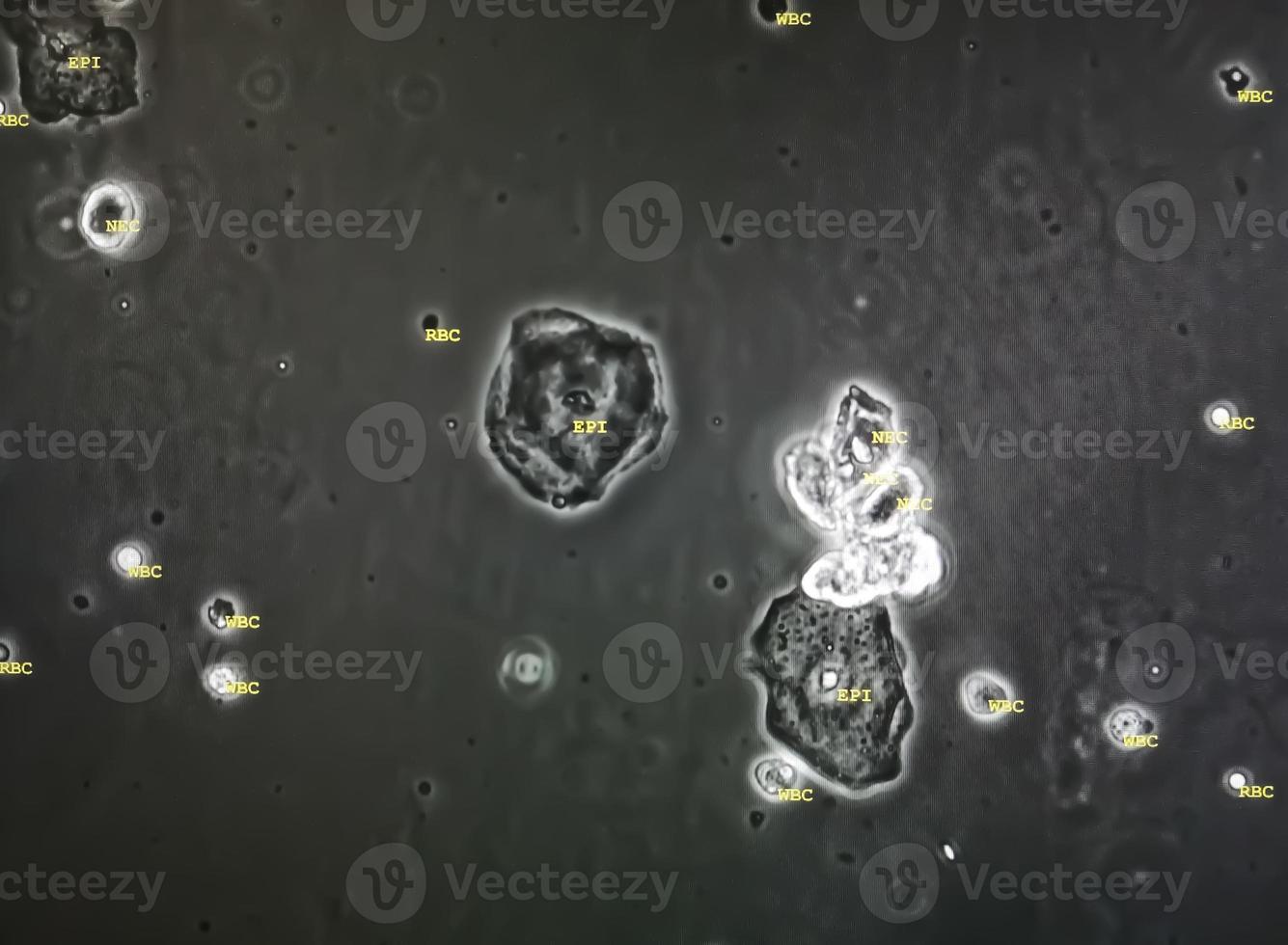 Microscopic image of abnormal urinalysis. urine exam. Urine routine examination. photo