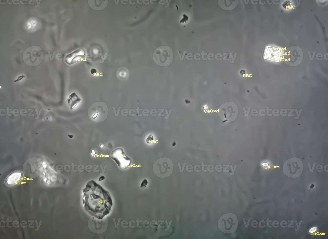 Microscopic image of abnormal urinalysis. urine exam. Urine routine examination. photo