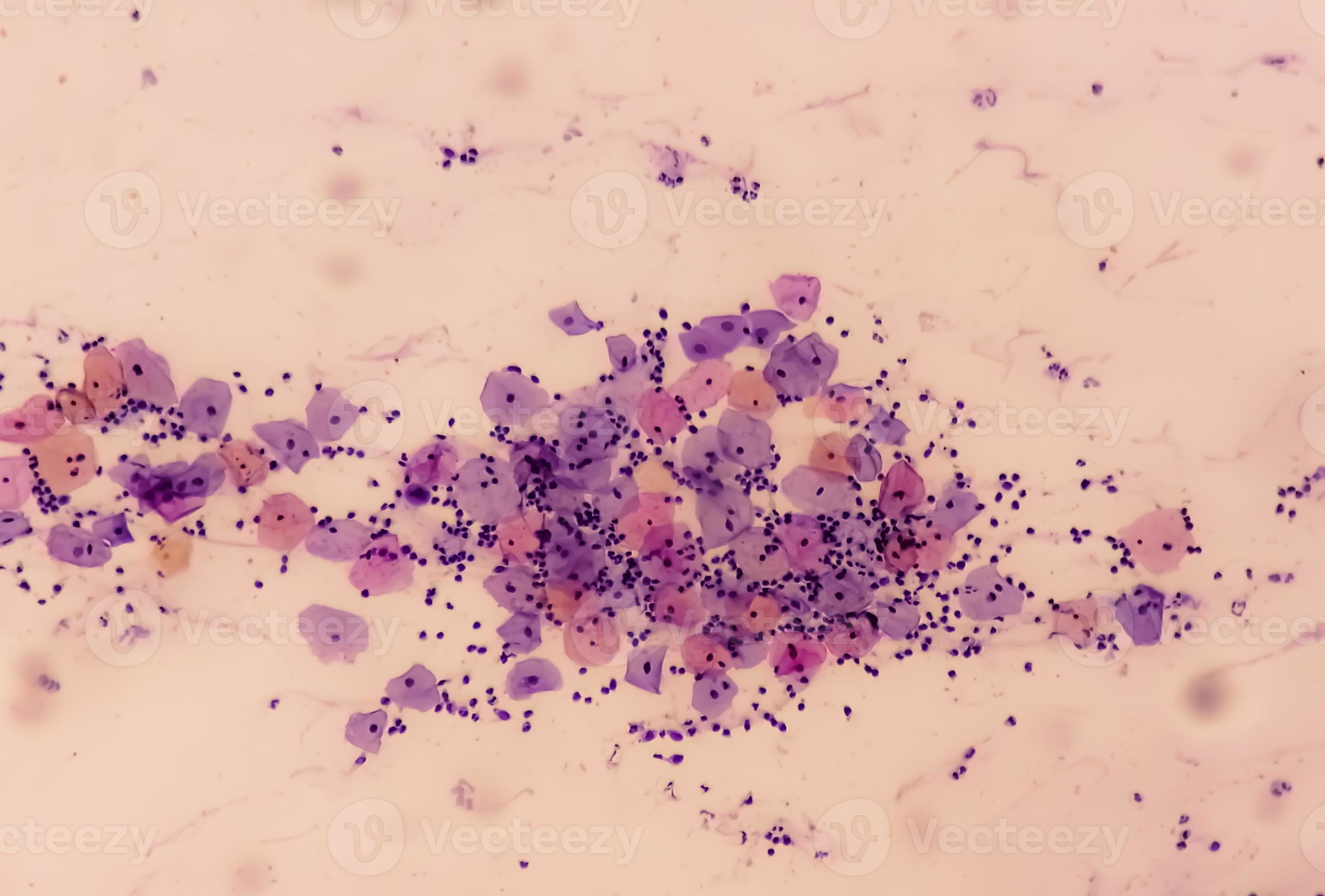 Microscopic view of PAP'S smear showing severe negative for Microscopic view of PAP'S smear showing severe negative for