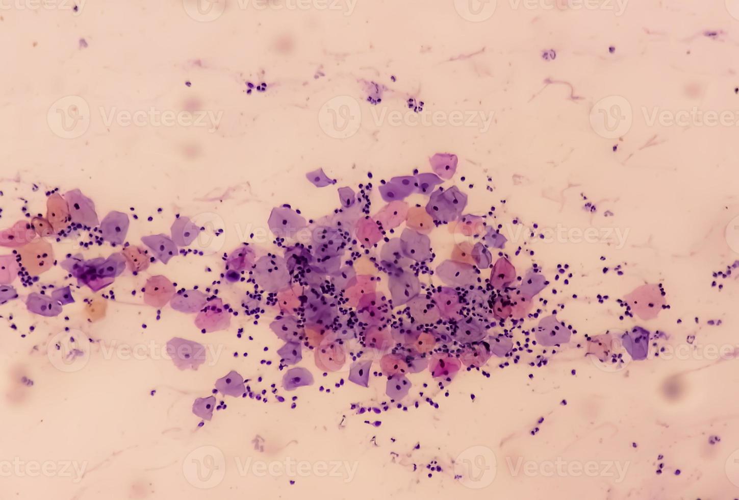 vista microscópica de la prueba de Papanicolaou que muestra un negativo grave para la malignidad de la lesión intraepitelial o nilm. diagnóstico de cáncer de cuello uterino. foto