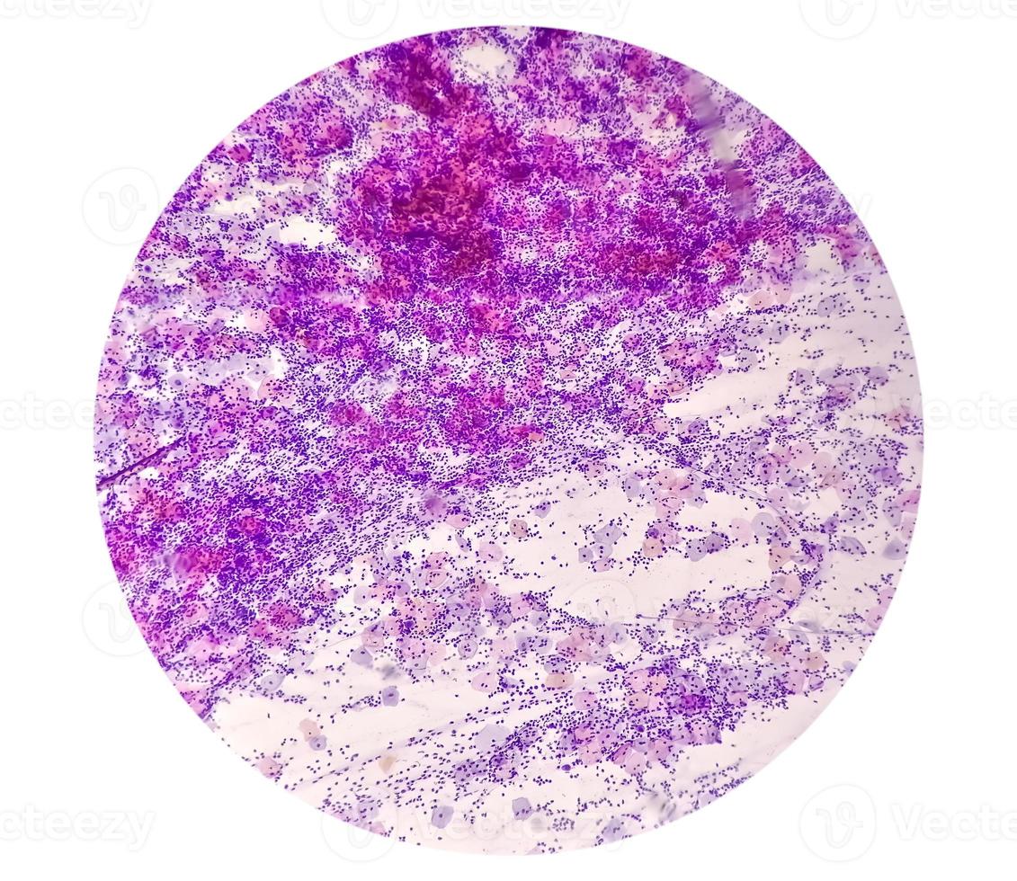 Microscopic view of PAP'S smear showing severe negative for intraepithelial lesion malignancy or NILM.  cervical cancer diagnosis. photo