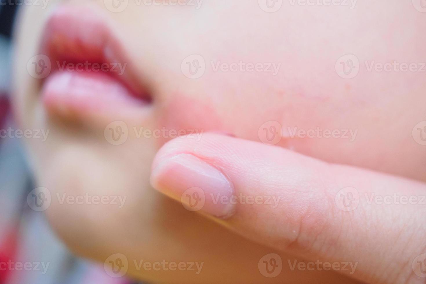 mother applying topical antihistamine cream at kid face with skin rash and allergy with red spot cause by mosquito bite photo