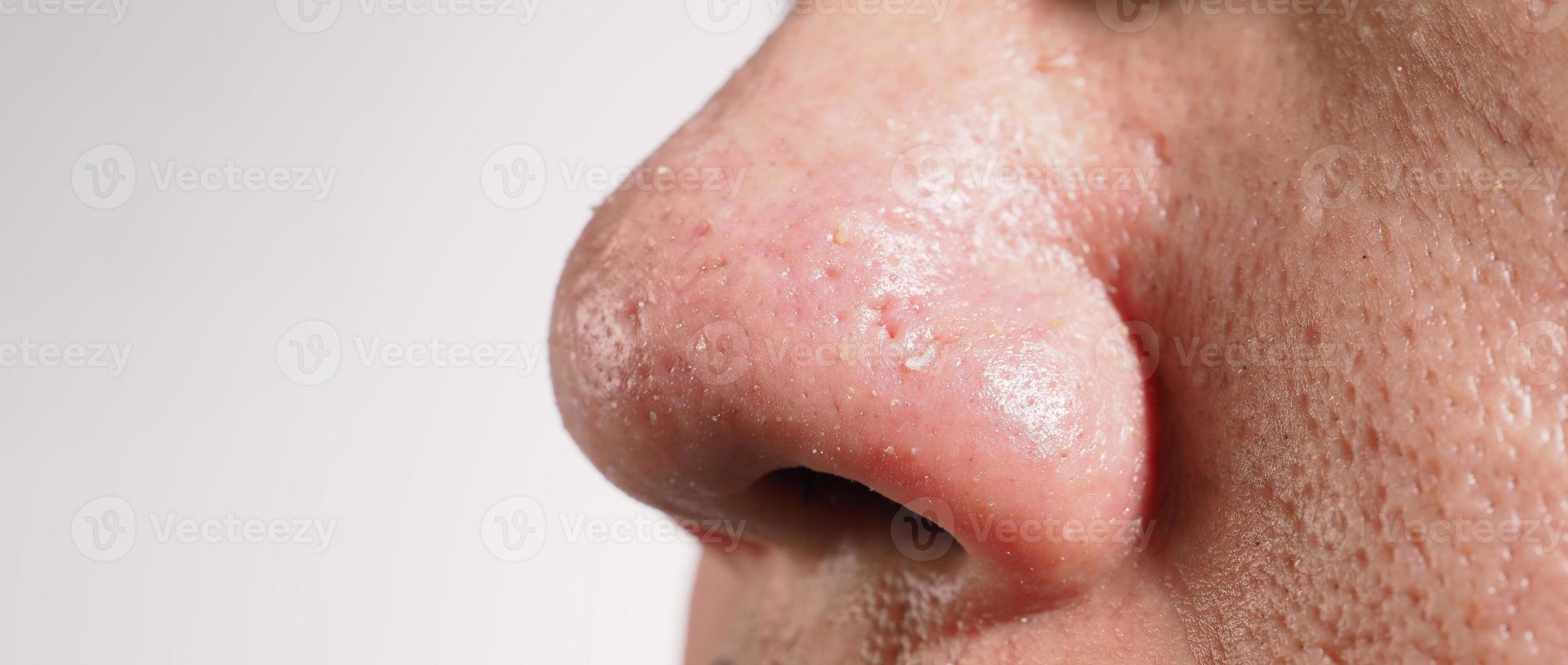 Acne and problem pores. White and blackhead pimples from nose pores. photo