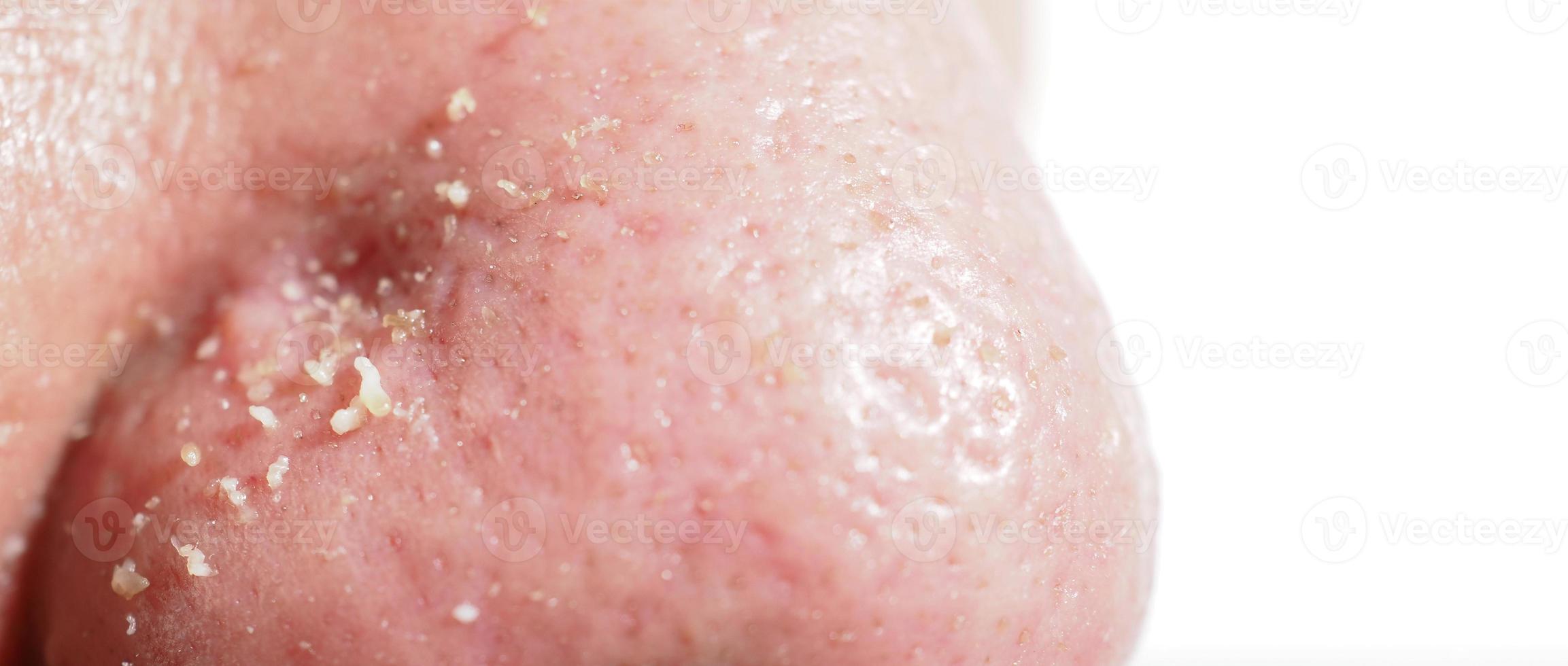 Acne and problem pores. White and blackhead pimples from nose pores. photo