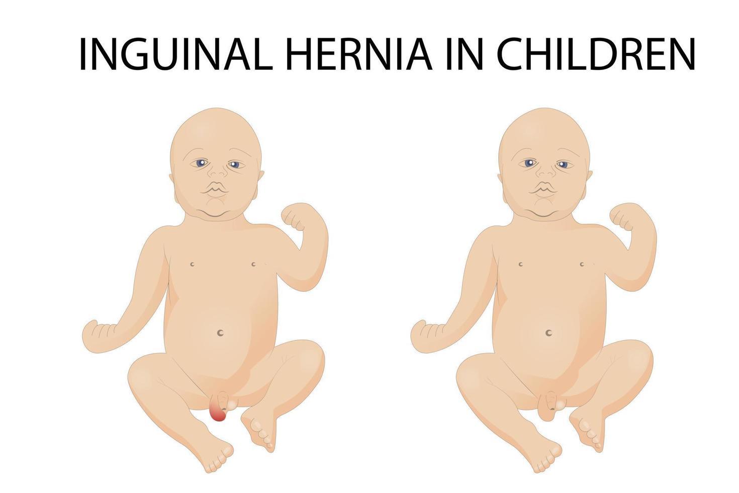 vector illustration of inguinal hernia in children