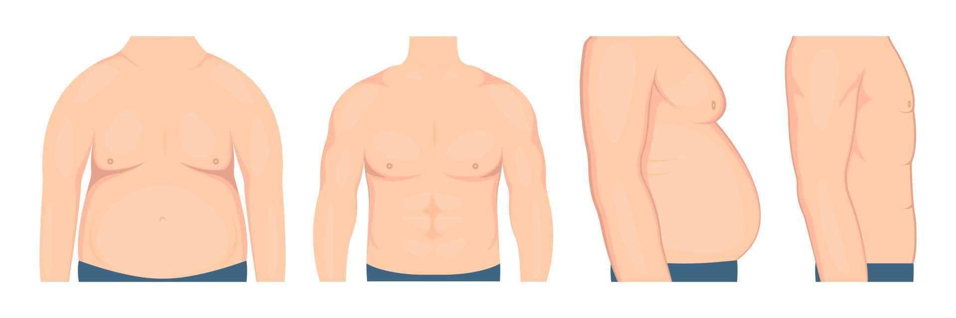 Vector illustration of gynecomastia in men before and after treatment. Human chest in a half-turn