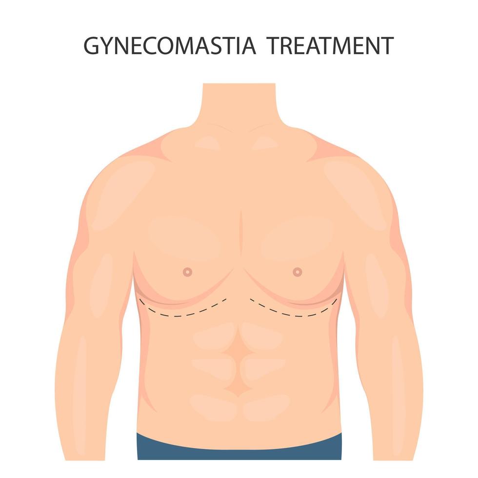Vector illustration of gynecomastia in men. For advertising cosmetic plastic procedures
