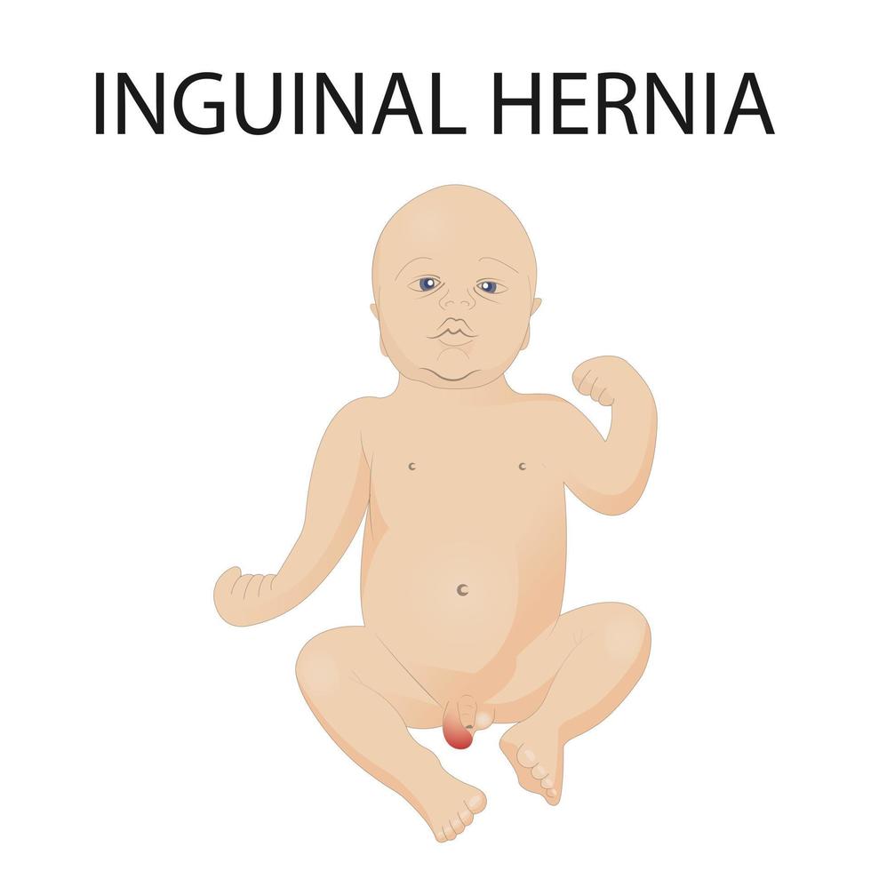 vector illustration of inguinal hernia in children