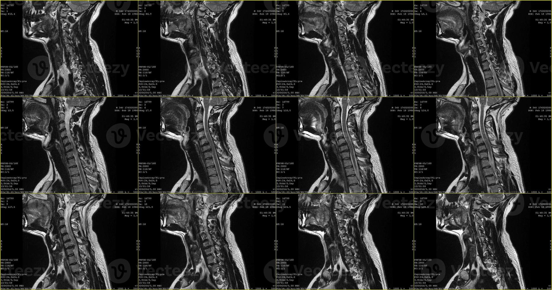 set of sagittal MRI scans of neck area of caucasian 34 years old male with bilateral paramedial extrusion of the C6-C7 segment with radiculopathy photo