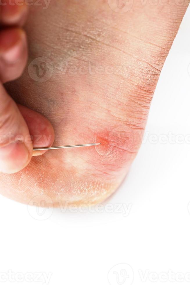 Blister on heel gets pricked with needle to burst it on white background, close-up with selective focus. photo