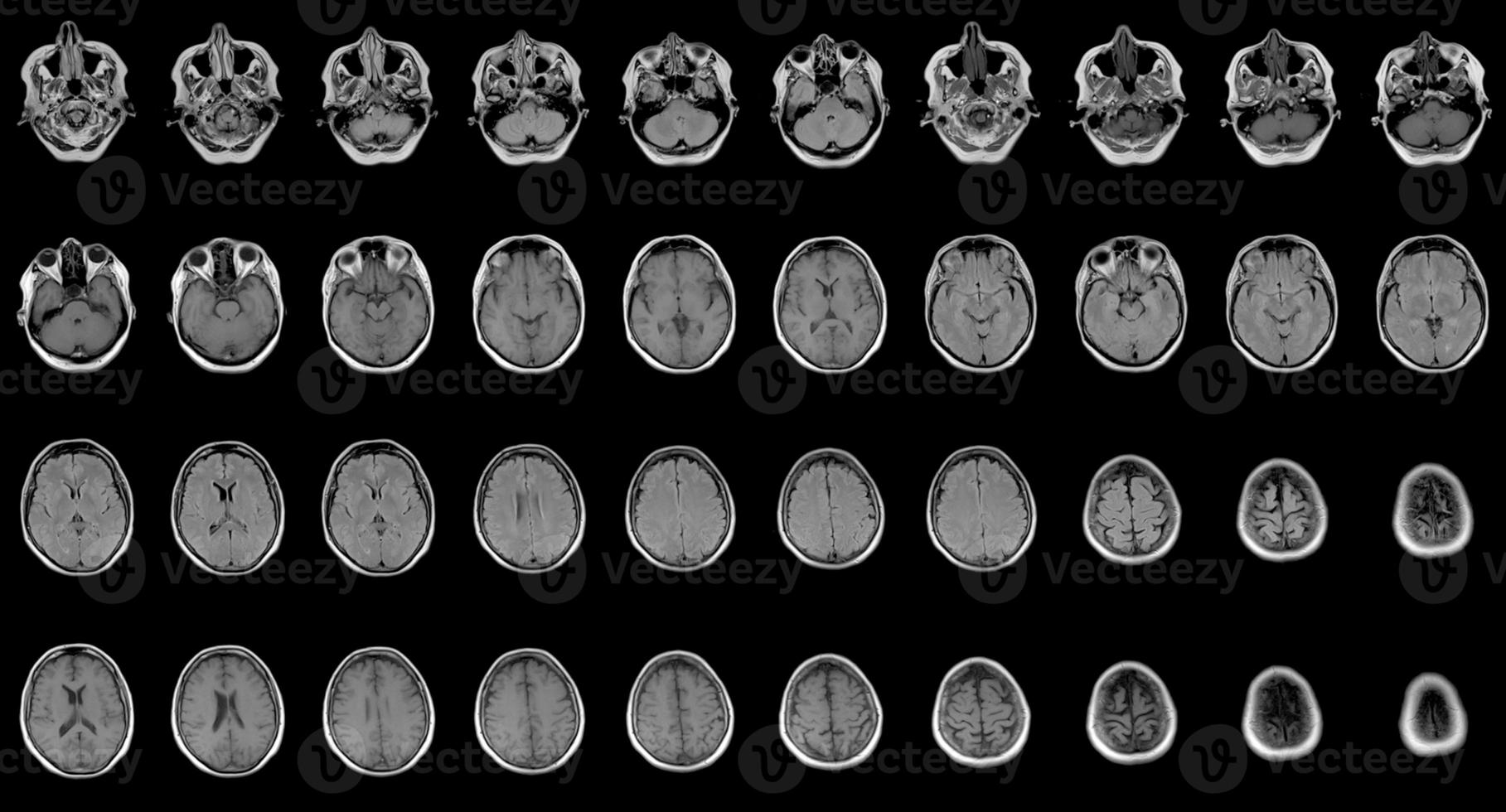 set of serial MRI scans of sixty years old caucasian female head photo