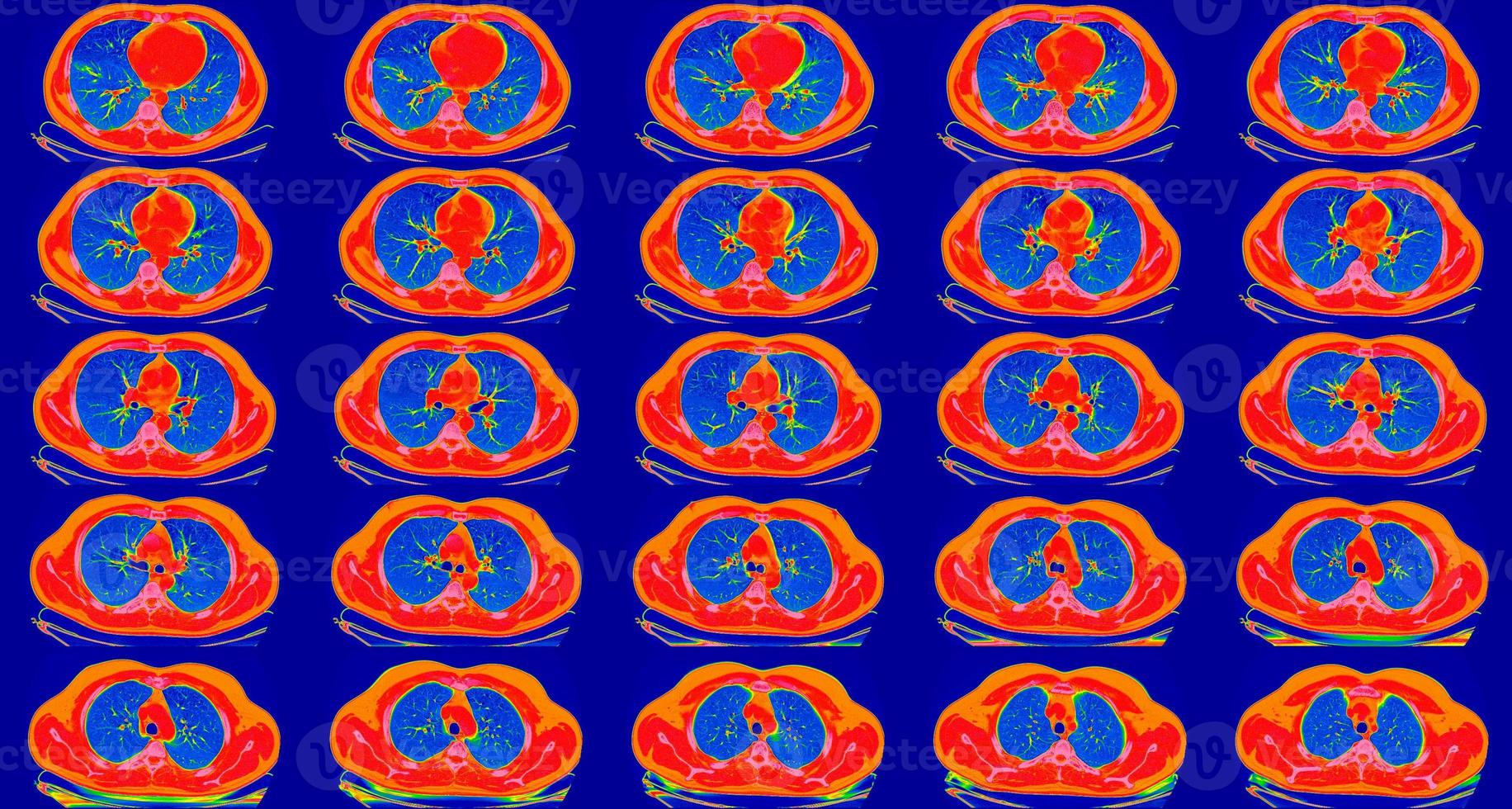 Computed tomography of the lungs in a healthy adult man. Normal lungs ct scan, spectral toned. May be part of COVID-19 diagnostic. photo
