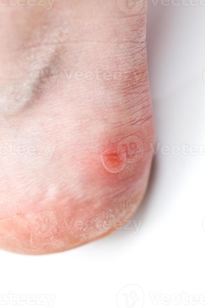 Small unpopped blister on heel, isolated on white background, close-up with selective focus. photo
