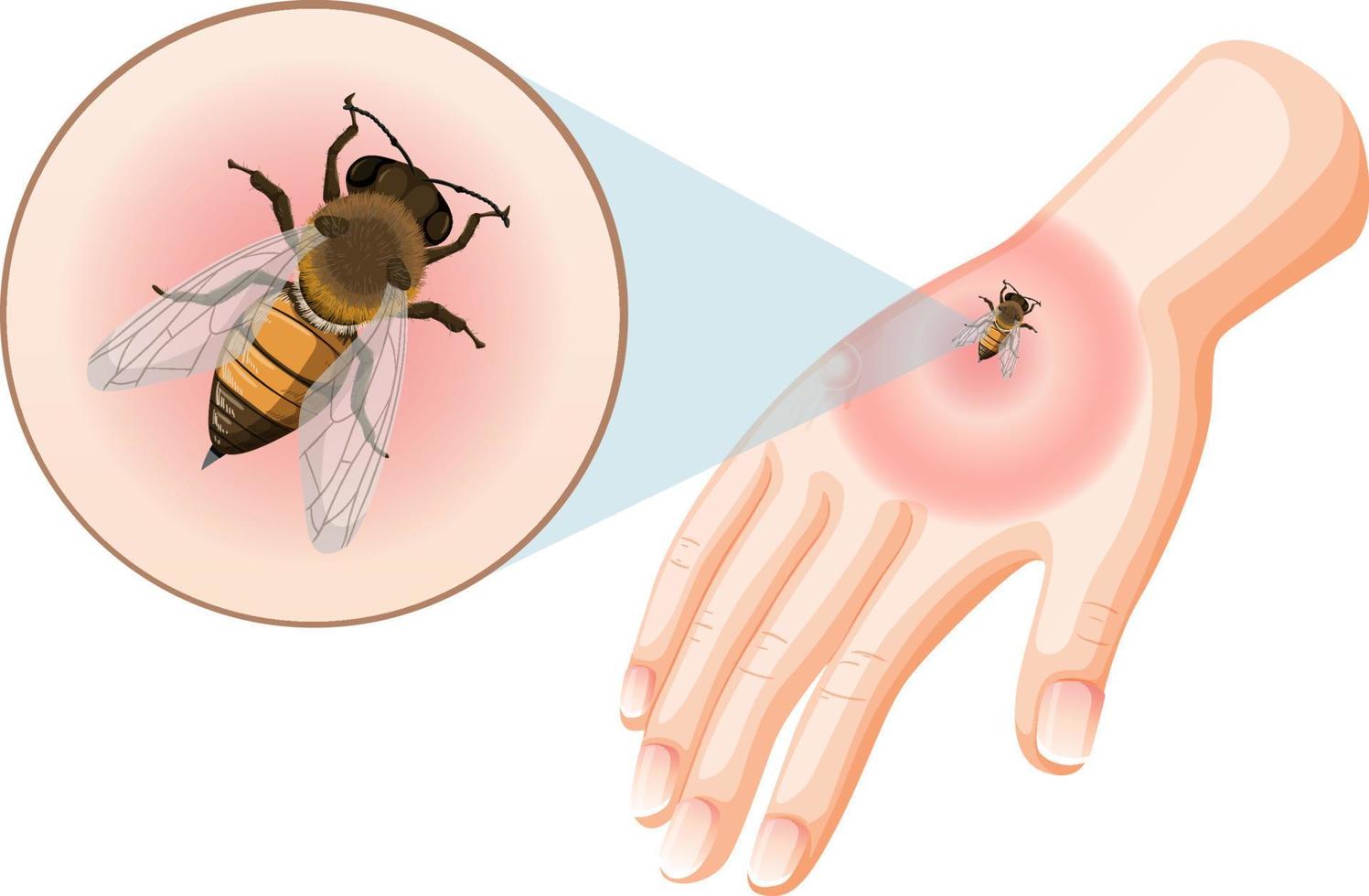 Bee bites sting on skin vector