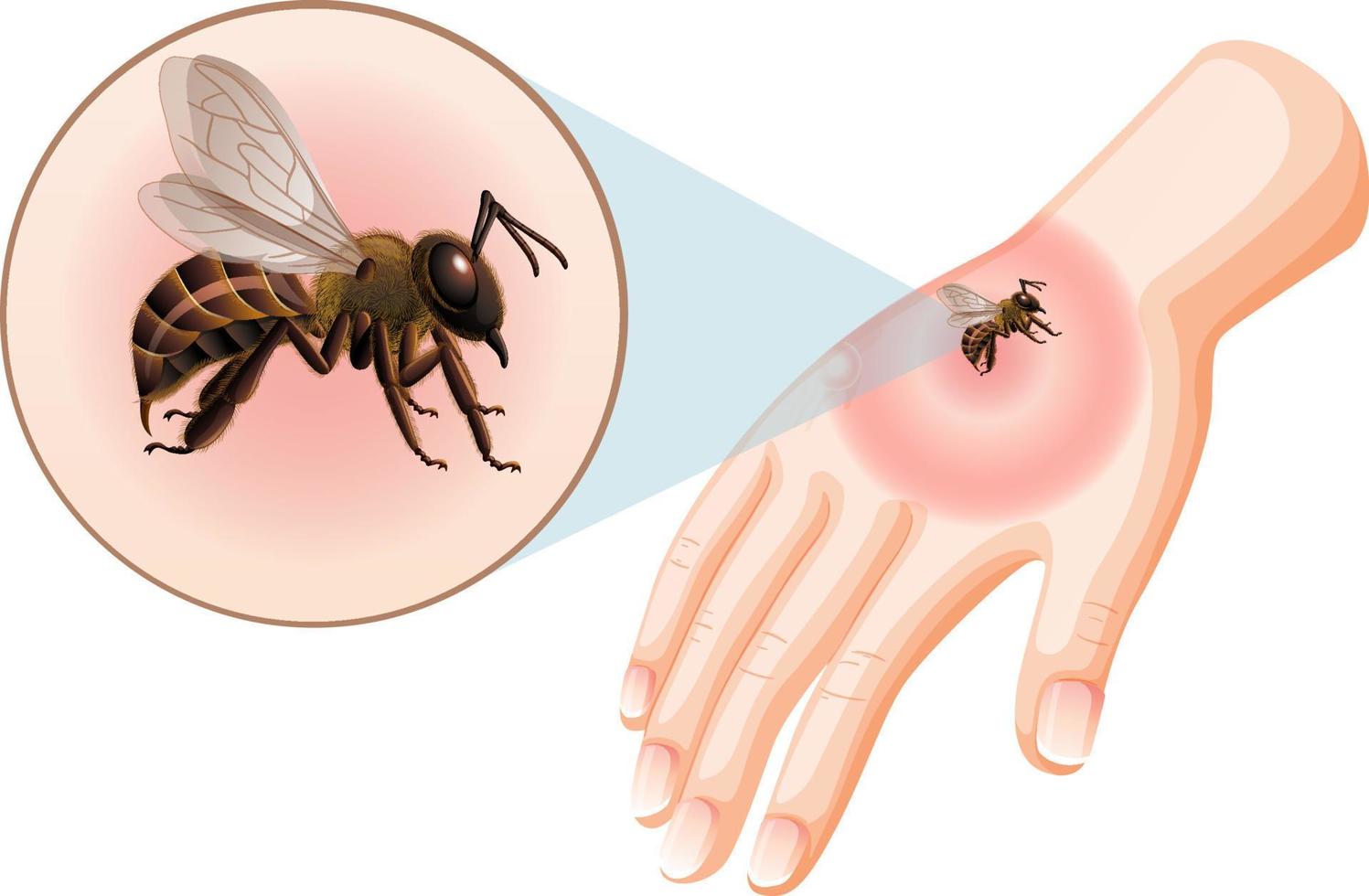 Bee bites sting on skin vector