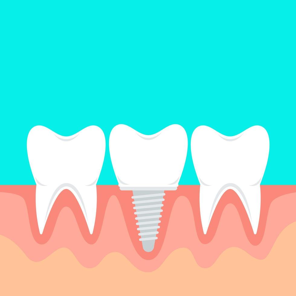 Human teeth and dental implant. Vector stock illustration in flat style with copy space.