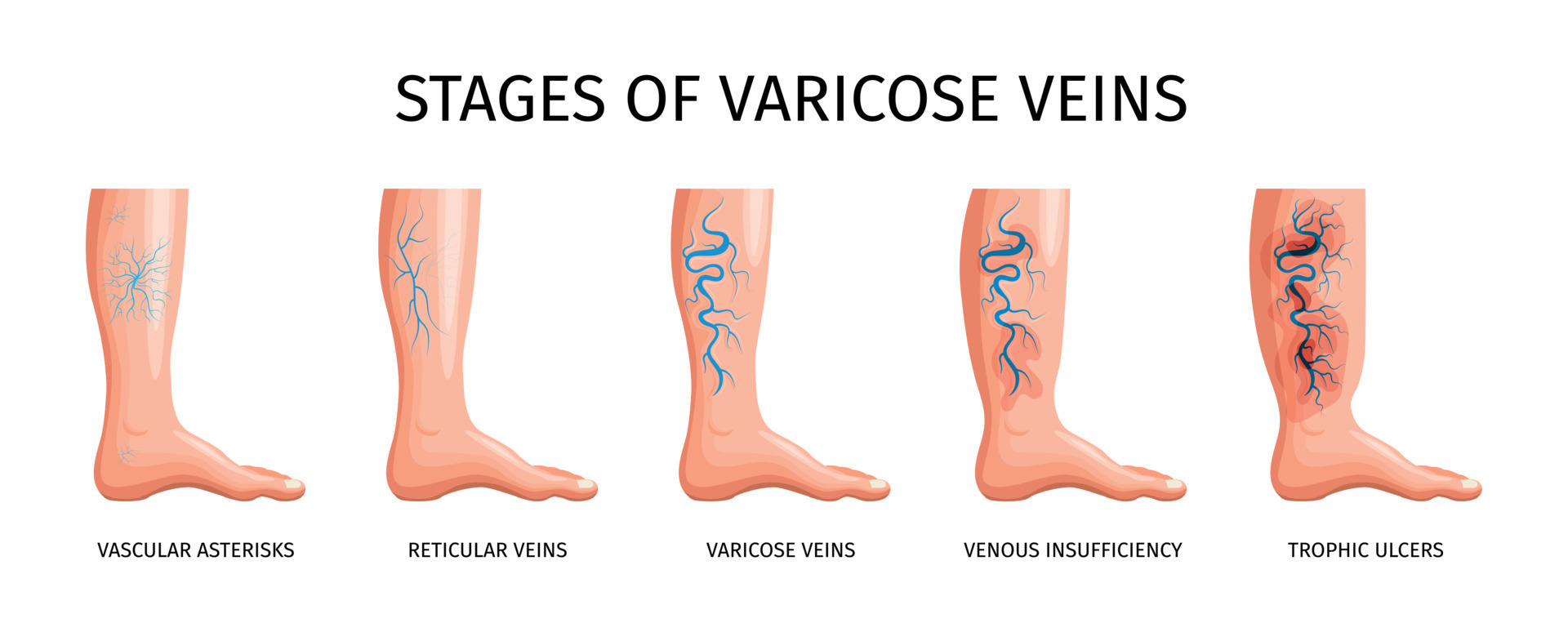 Stages Of Varicose Veins 12697004 Vector Art At Vecteezy