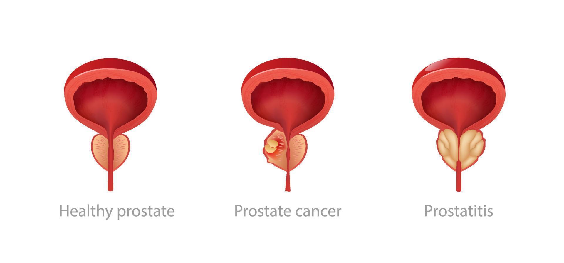 cáncer de salud de la próstata vector