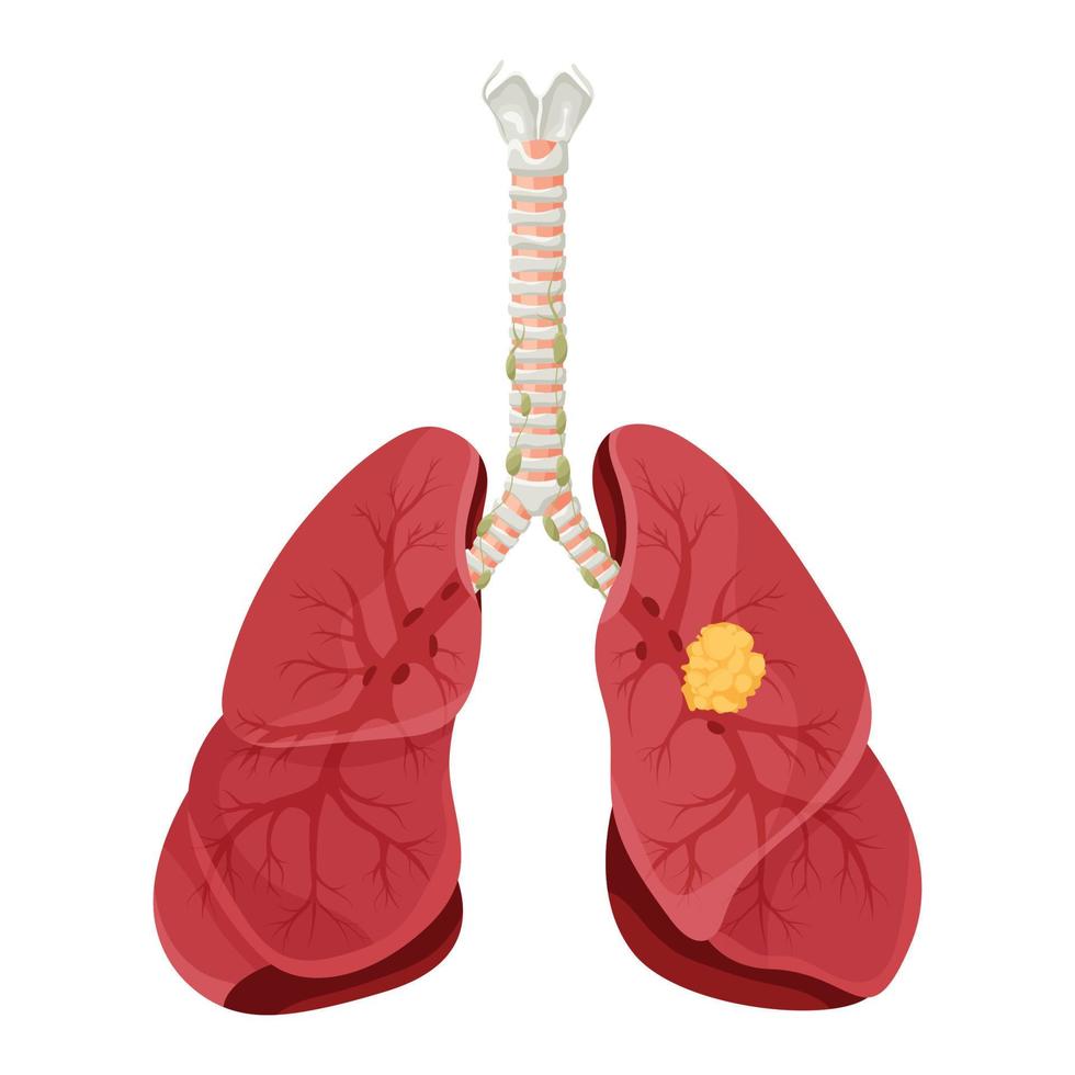 diagrama de enfermedad de cáncer de pulmón. concepto enfermedad órganos internos humanos. ilustración vectorial, estilo de dibujos animados. vector