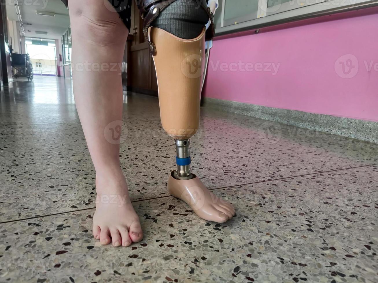 Disabled young women try to walk with prosthetics photo