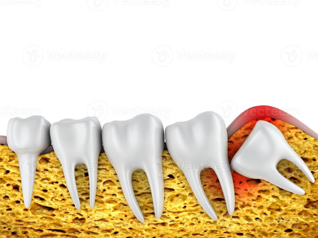 molars and  wisdom tooth photo